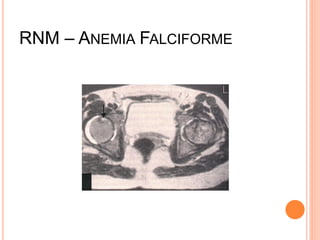 RNM – ANEMIA FALCIFORME
 