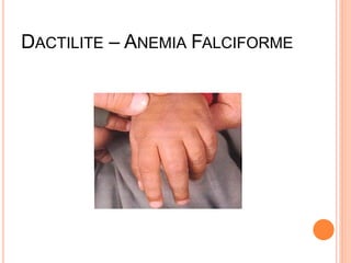 DACTILITE – ANEMIA FALCIFORME
 