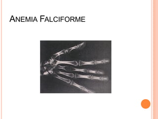 ANEMIA FALCIFORME
 