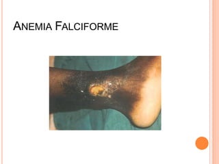 ANEMIA FALCIFORME
 