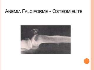 ANEMIA FALCIFORME - OSTEOMIELITE
 