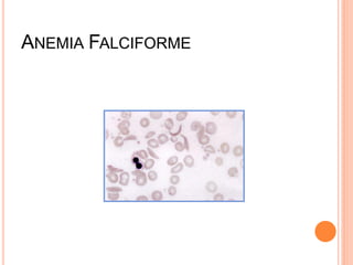 ANEMIA FALCIFORME
 