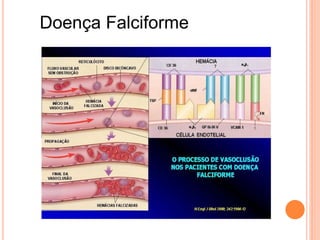 Doença Falciforme
 