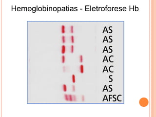 Hemoglobinopatias - Eletroforese Hb
 