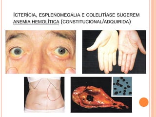 ICTERÍCIA, ESPLENOMEGALIA E COLELITÍASE SUGEREM
ANEMIA HEMOLÍTICA (CONSTITUCIONAL/ADQUIRIDA)
 