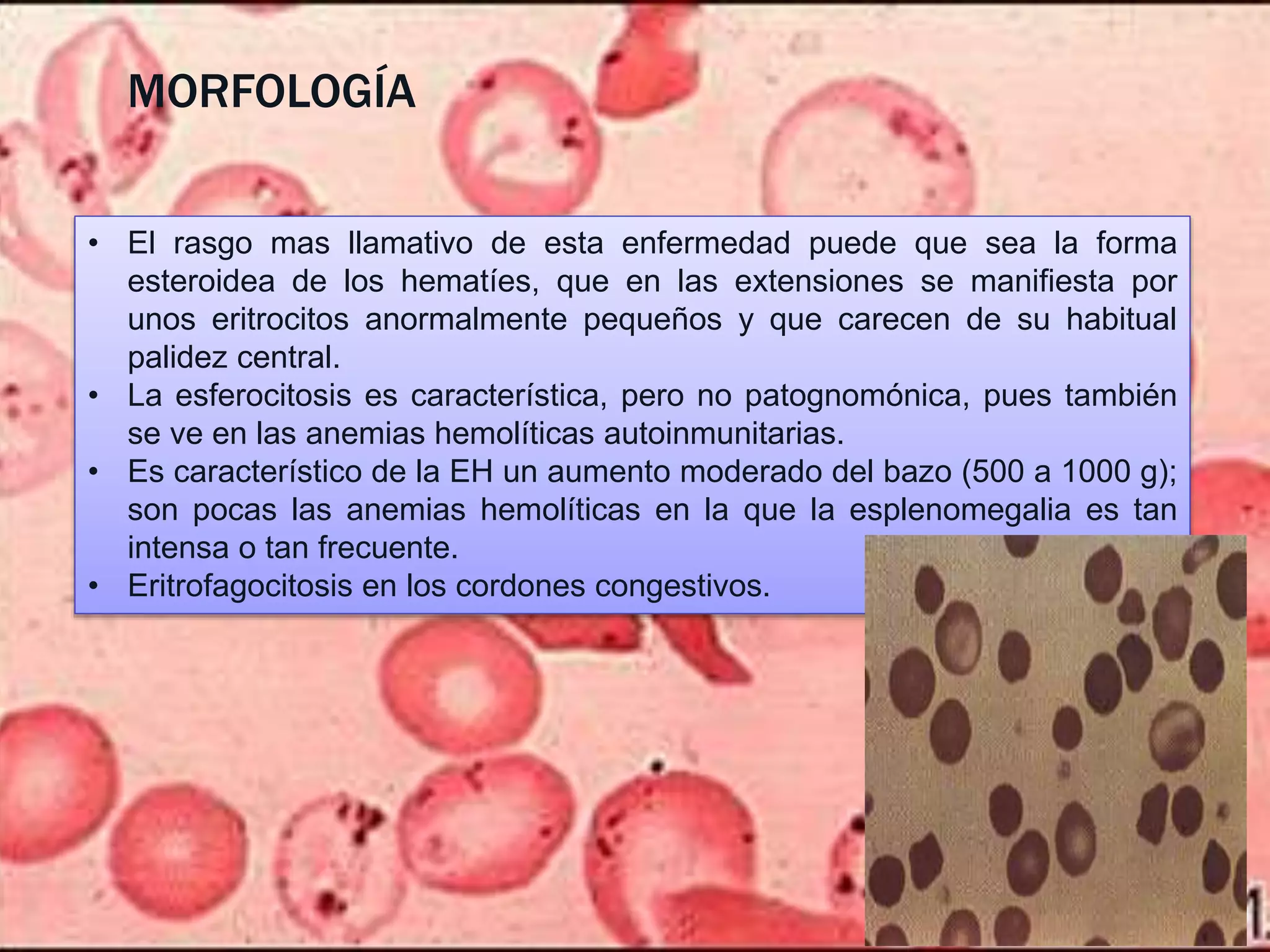 Anemia hemolitica | PPTX
