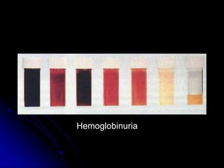 Hemoglobinuria
 