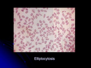 Elliptocytosis
 
