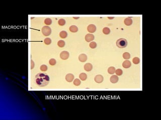 IMMUNOHEMOLYTIC ANEMIA
MACROCYTE
SPHEROCYTE
 