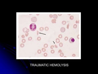 TRAUMATIC HEMOLYSIS
 