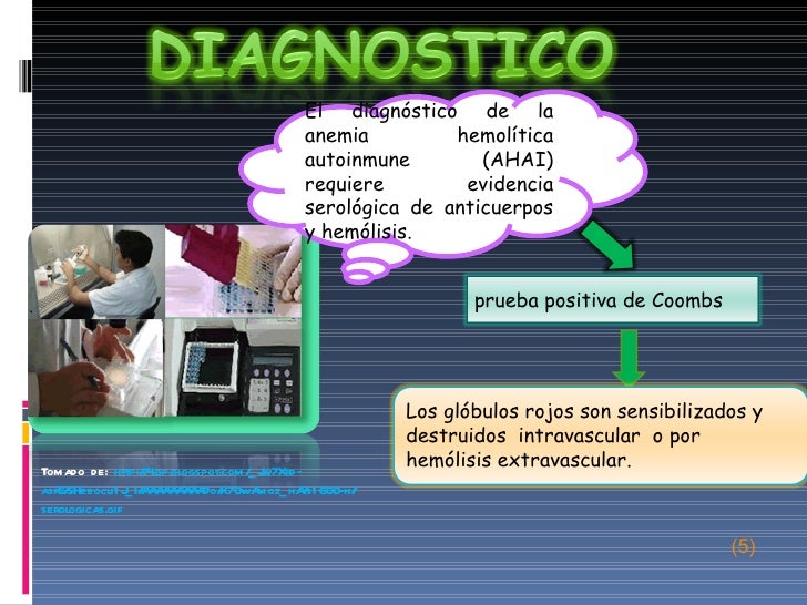 Anemia hemolitica1