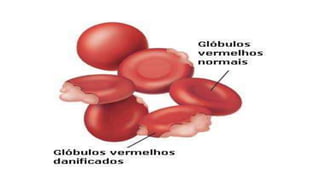 Anemia hemolitica 2