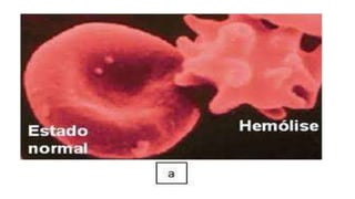 Anemia hemolitica 2