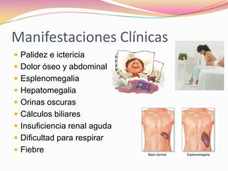 Manifestaciones Clínicas
 Palidez e ictericia
 Dolor óseo y abdominal
 Esplenomegalia
 Hepatomegalia
 Orinas oscuras
 Cálculos biliares
 Insuficiencia renal aguda
 Dificultad para respirar
 Fiebre
 