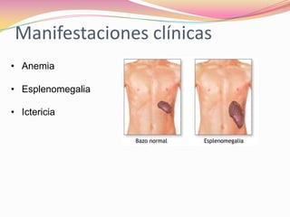 Manifestaciones clínicas
• Anemia
• Esplenomegalia
• Ictericia
 