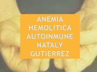 ANEMIA HEMOLITICA AUTOINMUNE NATALY GUTIERREZ 
