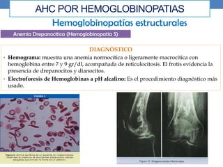 AHC POR HEMOGLOBINOPATIAS
Hemoglobinopatías estructurales
Anemia Drepanocitica (Hemoglobinopatía S)
DIAGNÓSTICO
• Hemograma: muestra una anemia normocítica o ligeramente macrocítica con
hemoglobina entre 7 y 9 gr/dl, acompañada de reticulocitosis. El frotis evidencia la
presencia de drepanocitos y dianocitos.
• Electroforesis de Hemoglobinas a pH alcalino: Es el procedimiento diagnóstico más
usado.
 