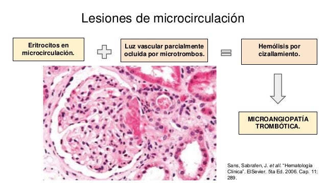 Anemia hemolítica microangiopática