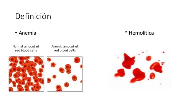 Anemia hemolítica por deficiencia de piruvato cinasa
