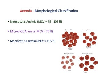 Anemia - Morphological Classification
• Normocytic Anemia (MCV = 75 - 105 fl)
• Microcytic Anemia (MCV < 75 fl)
• Macrocytic Anemia (MCV > 105 fl)
 