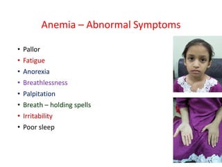 Anemia – Abnormal Symptoms
• Pallor
• Fatigue
• Anorexia
• Breathlessness
• Palpitation
• Breath – holding spells
• Irritability
• Poor sleep
 