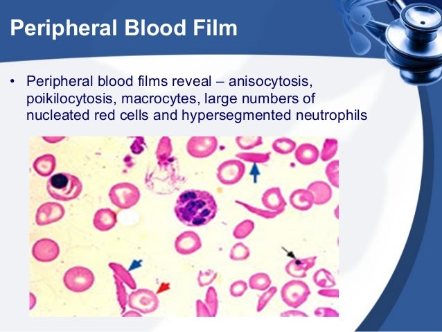 infection to to fever due reduce how Pregnancy in Anemia infection to to fever due reduce how Pregnancy in Anemia