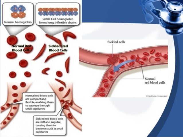 Anemia in Pregnancy