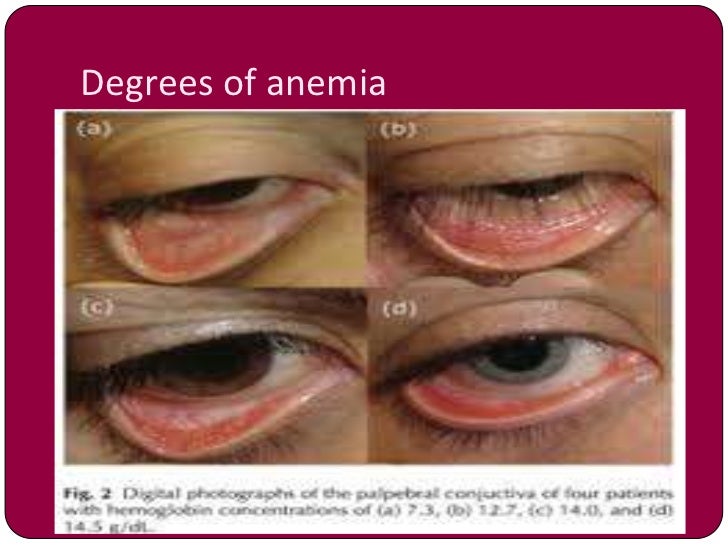 Anemia in pregnancy by dr shabnam naz