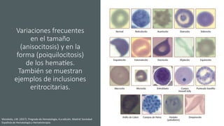 Variaciones frecuentes
en el tamaño
(anisocitosis) y en la
forma (poiquilocitosis)
de los hematíes.
También se muestran
ejemplos de inclusiones
eritrocitarias.
Moraleda, J.M. (2017). Pregrado de Hematología, 4.a edición. Madrid: Sociedad
Española de Hematología y Hematoterapia.
 