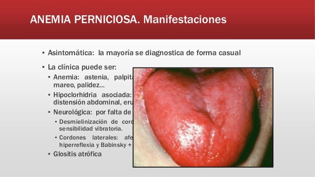 Anemia macrocitica y anemia perniciosa
