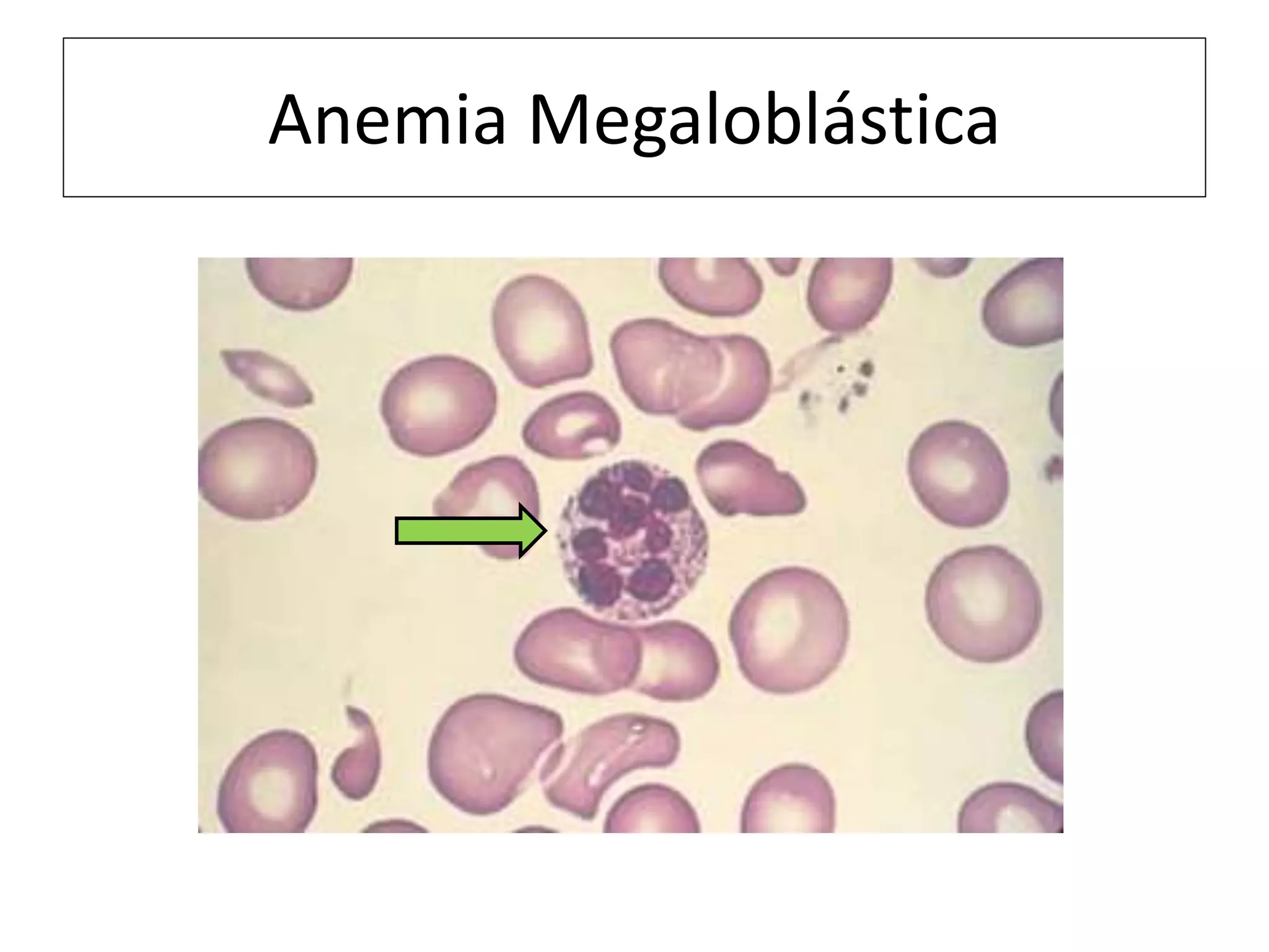 Anemia Megaloblástica