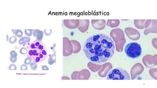 13
Anemia megaloblástica
 