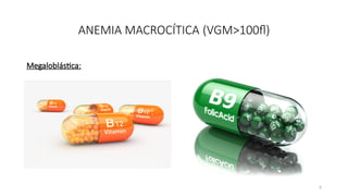 6
ANEMIA MACROCÍTICA (VGM>100fl)
Megaloblástica:
 