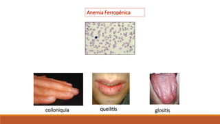 queilitis glositis
Anemia Ferropénica
coiloniquia
 