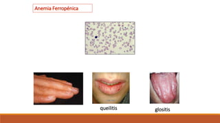 queilitis glositis
Anemia Ferropénica
 
