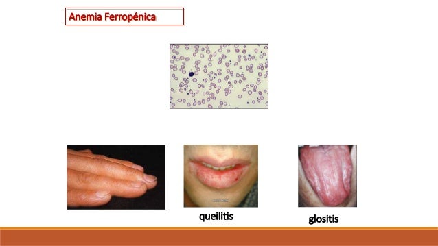 Anemia Ferropénica