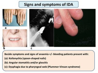 20
Beside symptoms and signs of anaemia +/- bleeding patients present with:
(a): Koilonychia (spoon-shaped nails)
(b): Angular stomatitis and/or glossitis
(c): Dysphagia due to pharyngeal web (Plummer-Vinson syndrome)
Signs and symptoms of IDA
a
c
b
 