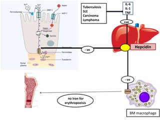 Hepcidin
BM macrophage
IL-6
IL-1
TNF
no Iron for
erythropoeisis
+ve
Tuberculosis
SLE
Carcinoma
Lymphoma
- ve
 