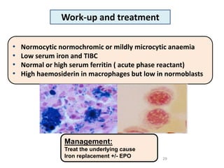 29
Management:
Treat the underlying cause
Iron replacement +/- EPO
• Normocytic normochromic or mildly microcytic anaemia
• Low serum iron and TIBC
• Normal or high serum ferritin ( acute phase reactant)
• High haemosiderin in macrophages but low in normoblasts
Work-up and treatment
 