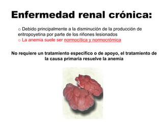 Enfermedad renal crónica:
o Debido principalmente a la disminución de la producción de
eritropoyetina por parte de los riñones lesionados
o La anemia suele ser normocítica y normocrómica
No requiere un tratamiento específico o de apoyo, el tratamiento de
la causa primaria resuelve la anemia
 