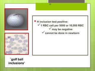31
                 0   or -thal 1 trait

               H inclusion test positive:
                1 RBC cell per 5000 or 10,000 RBC
                         may be negative
                    cannot be done in newborn




 `golf ball
inclusions’
 