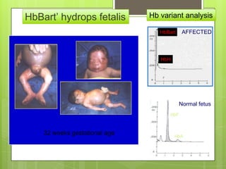 HbBart’ hydrops fetalis        Hb variant analysis

                                  HbBart    AFFECTED



                                  HbH




                                           Normal fetus
                                     HbF



    32 weeks gestational age            HbA
 