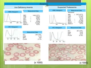 Anemia
         Iron Deficiency Anemia                                 Suspected Thalassemia
                   Messwerte                            <RBC-Histogram>        Measurement Data
                          Measurement Data
<RBC-Histogram>                                                            Messwerte
                                                                           RBC         + 5.97 x1012/L
                   RBC             4.48 x1012/L                                              12.7g/dl
                                                                           HGB
                   HGB        –         8.8g/dl                                                41.1%
                                                                           HCT
                   HCT        –          29.3%
                                                                           MCV         –        68.8fl
                   MCV        –           65.4fl
                                                                           MCH         –      21.3pg
                   MCH        +         19.6pg
                                                                           MCHC        –     30.9g/dl
                   MCHC                30.0g/dl                                                14.7%
                                                                           RDW-CV
                   RDW-CV                18.2%
<PLT-Histogram>
                                                        <PLT-Histogram>       Measurement Data

                                                                           PLT             391 x109/L
                         Measurement Data                                  PDW                  12.0fl
                   Messwerte
                                                                           MPV                  10.3fl
                   PLT               235 x109/L
                                                                           P-LCR               27.3%
                   PDW                     11.7fl
                   MPV                      9.4fl
                   P-LCR                  21.7%




                                     (x 1000)                                                   (x 1000)
 