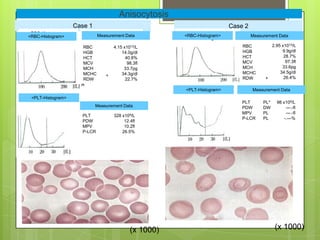 Anisocytosis
                   Case 1                                                Case 2
 RBC-Histogramm       Messwerte
<RBC-Histogram>            Measurement Data           <RBC-Histogram>           Measurement Data
                                                        RBC-Histogramm       Messwerte

                      RBC          4.15 x1012/L                              RBC         2.95 x1012/L
                      HGB              14.0g/dl                              HGB              9.9g/dl
                      HCT                40.8%                               HCT               28.7%
                      MCV                 98.3fl                             MCV                97.3fl
                      MCH               33.7pg                               MCH              33.6pg
                      MCHC             34.3g/dl                              MCHC            34.5g/dl
                               +                                                               26.4%
                      RDW                22.7%                               RDW       +

                                                      <PLT-Histogram>             Measurement Data
 <PLT-Histogram>
                                                                             PLT      PL*   98 x109/L
                      Messwerte
                          Measurement Data                                   PDW      DW         ---.-fl
                                                                             MPV      PL         ---.-fl
                     PLT           328 x109/L
                                                                             P-LCR    PL        -.---%
                     PDW                12.4fl
                     MPV                10.2fl
                     P-LCR             26.5%




                                           (x 1000)                                         (x 1000)
 
