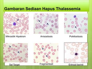 Gambaran Sediaan Hapus Thalassemia




Mikrositik Hipokrom   Anisositosis   Poikilositosis




   Sel Target         Fragmentosit   Eritrosit berinti
 