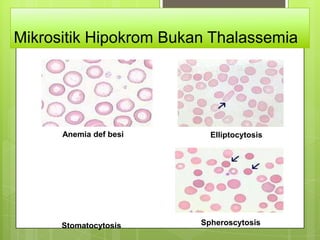 Mikrositik Hipokrom Bukan Thalassemia




      Anemia def besi     Elliptocytosis




      Stomatocytosis    Spheroscytosis
 