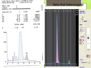 Beta thal heterozygote
 