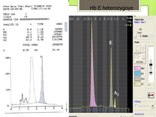 Hb E heterozygoye




       E




           A2
 