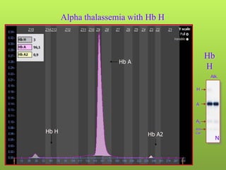 Alpha thalassemia with Hb H



                                            Hb
                      Hb A
                                            H
                                             Alk.

                                     H


                                     A


                                     A2

Hb H
                                     Anh.
                             Hb A2   Car.
                                                 N
 