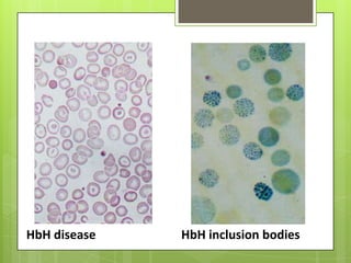 HbH disease   HbH inclusion bodies
 